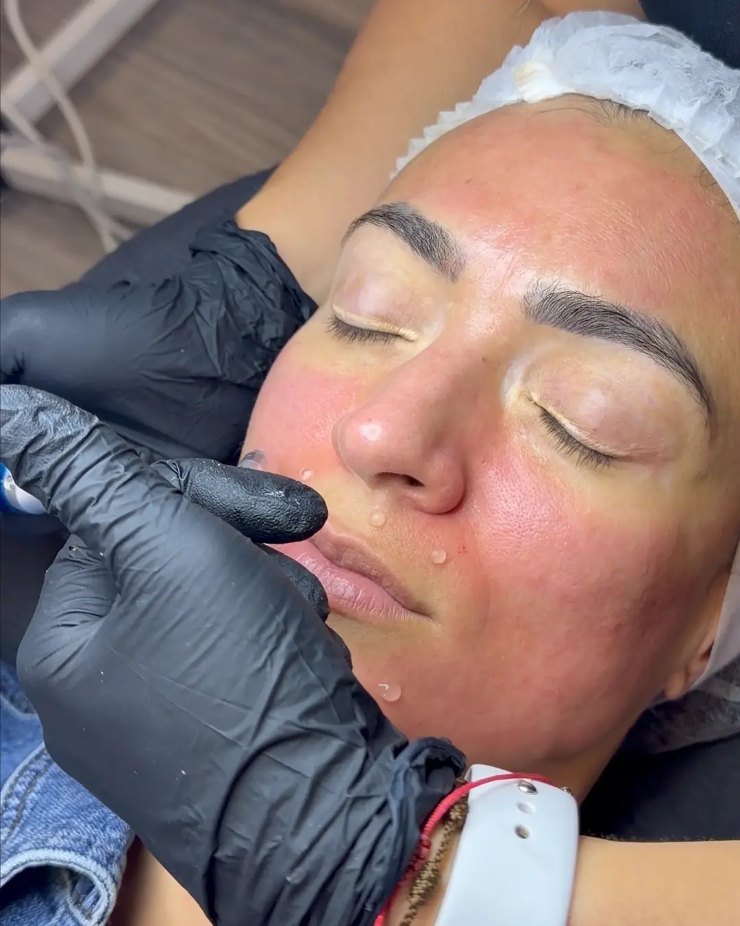 Facial profundo con plasma rico en plaquetas
